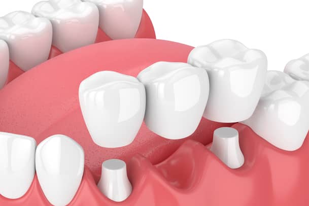 Treatment - Priors Hall Dental