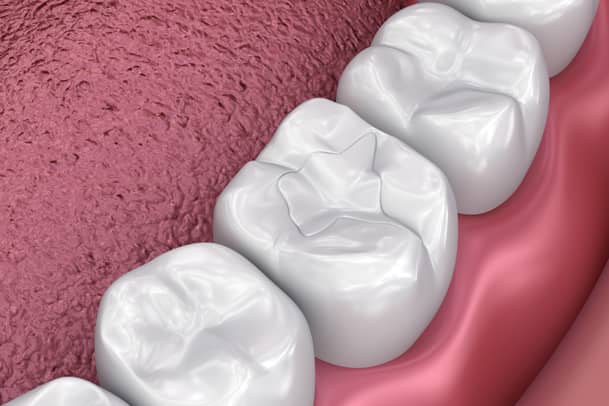 Treatment - Priors Hall Dental